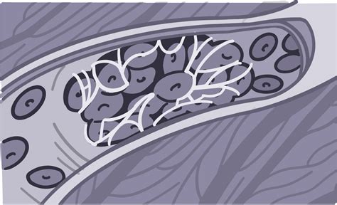clotsiti|Blood Clots Explained .